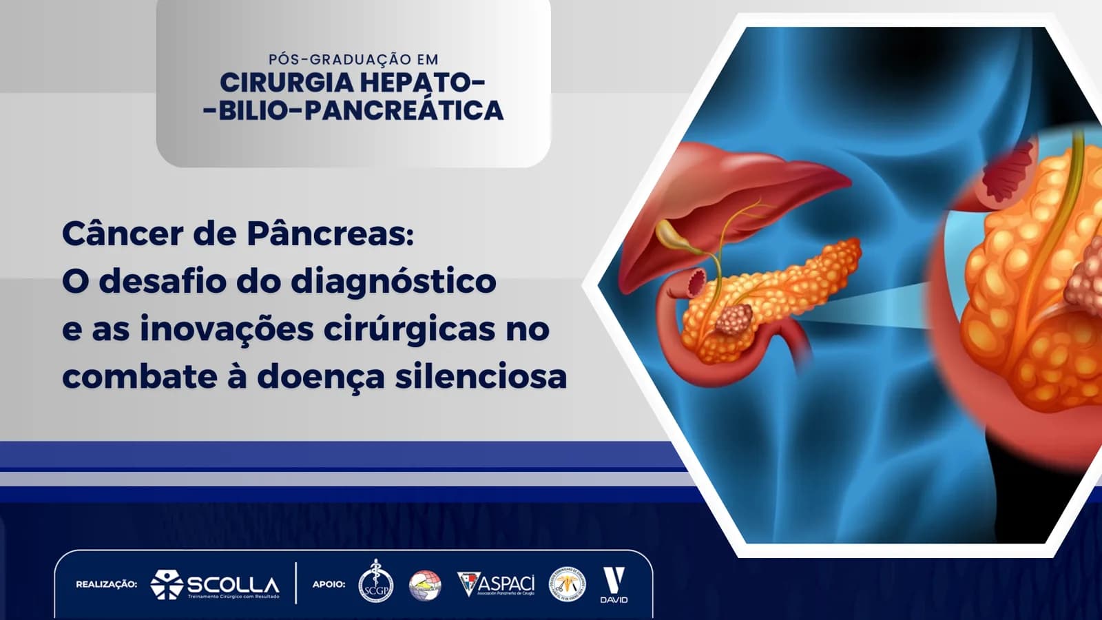 Câncer de Pâncreas: O desafio do diagnóstico e as inovações cirúrgicas no combate à doença silenciosa